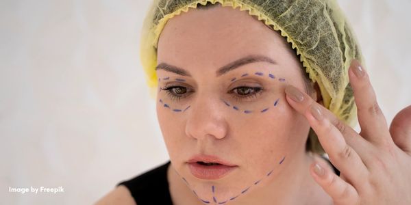 Antes y después — relleno facial